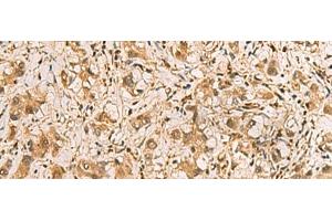 Immunohistochemistry of paraffin-embedded Human liver cancer tissue using PDXK Polyclonal Antibody at dilution of 1:75(x200) (PDXK anticorps)