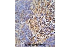 HLA-DRB5 Antibody (Center) (ABIN653782 and ABIN2843069) immunohistochemistry analysis in formalin fixed and paraffin embedded human lung carcinoma followed by peroxidase conjugation of the secondary antibody and DAB staining. (HLA-DRB5 anticorps  (AA 43-70))