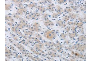 The image on the left is immunohistochemistry of paraffin-embedded Human liver cancer tissue using ABIN7190267(CKMT1A/CKMT1B Antibody) at dilution 1/80, on the right is treated with synthetic peptide. (CKMT1A anticorps)