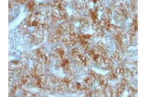Formalin-fixed, paraffin-embedded human renal cell carcinoma stained with Cadherin 16 antibody (CDH16/1071) (Cadherin-16 anticorps)