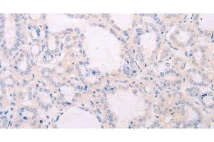Immunohistochemistry of paraffin-embedded Human thyroid cancer tissue using TSHR Polyclonal Antibody at dilution 1:50 (TSH receptor anticorps)