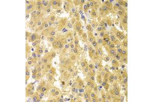 Immunohistochemistry of paraffin-embedded human liver cancer using GMNN antibody. (Geminin anticorps  (AA 1-209))