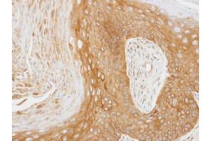 IHC-P Image Immunohistochemical analysis of paraffin-embedded Cal27 xenograft, using 14-3-3 zeta, antibody at 1:100 dilution.