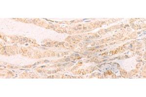 Immunohistochemistry of paraffin-embedded Human thyroid cancer tissue using EREG Polyclonal Antibody at dilution of 1:35(x200)