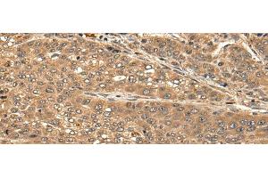 Immunohistochemistry of paraffin-embedded Human liver cancer tissue using CBLN3 Polyclonal Antibody at dilution of 1:25(x200) (CBLN3 anticorps)