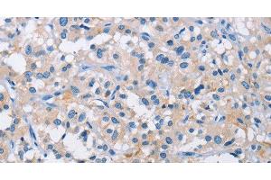 Immunohistochemistry of paraffin-embedded Human thyroid cancer tissue using ATP6AP2 Polyclonal Antibody at dilution 1:50 (ATP6AP2 anticorps)