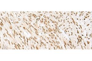 Immunohistochemistry of paraffin-embedded Human liver cancer tissue using NHP2 Polyclonal Antibody at dilution of 1:55(x200) (NHP2 anticorps)