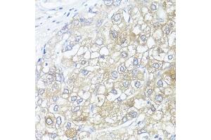 Immunohistochemistry of paraffin-embedded human liver cancer using ASL antibody (ABIN6127448, ABIN6137201, ABIN6137202 and ABIN6221972) at dilution of 1:100 (40x lens).