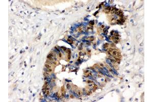 Anti- HINT1 Picoband antibody, IHC(P) IHC(P): Human Intestinal Cancer Tissue