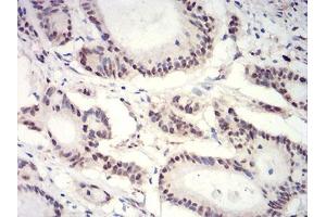 Immunohistochemical analysis of paraffin-embedded colon cancer tissues using HIST2H3C(27Ac) mouse mAb with DAB staining. (Histone Cluster 2, H3c (HIST2H3C) (acLys27) anticorps)