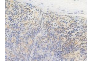 ABIN6264249 and ABIN6269096 at 1/100 staining human melanoma by IHC-P. (Pkc beta 1 anticorps  (C-Term))