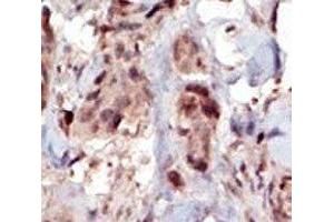 IHC analysis of FFPE human breast carcinoma tissue stained with the SPHK2 antibody (SPHK2 anticorps  (AA 590-620))
