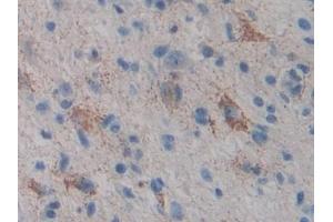 Detection of CYP21A2 in Human Glioma Tissue using Polyclonal Antibody to Cytochrome P450 Family 21 Subfamily A Member 2 (CYP21A2)