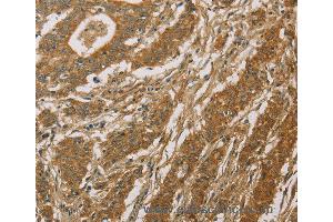 Immunohistochemistry of Human thyroid cancer using CYP39A1 Polyclonal Antibody at dilution of 1:50 (CYP39A1 anticorps)