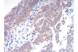 Immunohistochemical analysis of paraffin-embedded endometrial cancer tissues using TBCC mouse mAb with DAB staining.