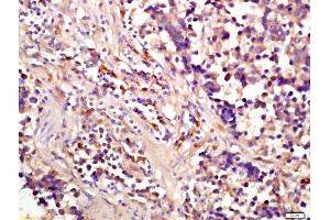 Formalin-fixed and paraffin embedded human lung carcinoma labeled with Anti-phospho-eIF4EBP1(Ser64) Polyclonal Antibody, Unconjugated (ABIN682963) at 1:200 followed by conjugation to the secondary antibody and DAB staining (eIF4EBP1 anticorps  (pSer65))