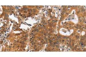 Immunohistochemistry of paraffin-embedded Human gastic cancer using ITGA2 Polyclonal Antibody at dilution of 1:30 (ITGA2 anticorps)