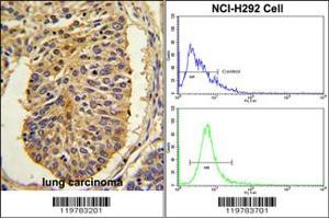 (LEFT)Formalin-fixed and paraffin-embedded human lung carcinoma with CER1 Antibody (N-term), which was peroxidase-conjugated to the secondary antibody, followed by DAB staining. (CER1 anticorps  (N-Term))