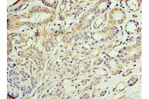 Immunohistochemistry of paraffin-embedded human breast cancer using ABIN7142902 at dilution of 1:100 (AKAP1 anticorps  (AA 413-662))