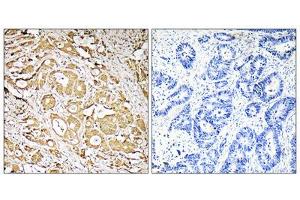 Immunohistochemistry analysis of paraffin-embedded human colon carcinoma tissue, using MRPS7 antibody. (FUT3 anticorps  (Internal Region))