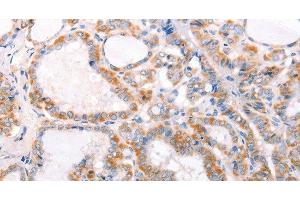Immunohistochemistry of paraffin-embedded Human thyroid cancer using TRAF5 Polyclonal Antibody at dilution of 1:30 (TRAF5 anticorps)