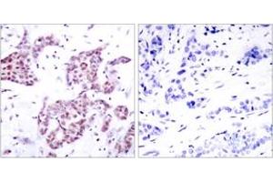 Immunohistochemistry analysis of paraffin-embedded human breast carcinoma, using STAT6 (Phospho-Tyr641) Antibody. (STAT6 anticorps  (pTyr641))