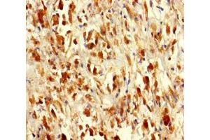 Immunohistochemistry of paraffin-embedded human melanoma using ABIN7168949 at dilution of 1:100 (Seryl-tRNA Synthetase (SARS) (AA 2-233) anticorps)