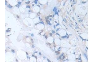 Detection of CAP3 in Human Bile duct cancer Tissue using Polyclonal Antibody to Cytoplasmic Antiproteinase 3 (CAP3)