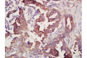 Formalin-fixed and paraffin embedded human lung carcinoma labeled with Rabbit Anti-Prostaglandin E Receptor EP4 Polyclonal Antibody, Unconjugated (ABIN1387963) at 1:200 followed by conjugation to the secondary antibody and DAB staining (PTGER4 anticorps  (AA 151-250))