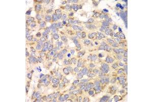 Immunohistochemistry of paraffin-embedded human esophageal cancer using HAGH antibody at dilution of 1:100 (x40 lens). (HAGH anticorps)