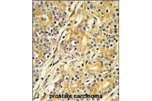 Formalin-fixed and paraffin-embedded human prostate carcinoma reacted with CYP51A1 Antibody (C-term), which was peroxidase-conjugated to the secondary antibody, followed by DAB staining.