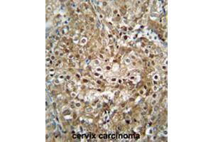 CF153 antibody (C-term) immunohistochemistry analysis in formalin fixed and paraffin embedded human cervix carcinoma followed by peroxidase conjugation of the secondary antibody and DAB staining. (CF153 (AA 233-263), (C-Term) anticorps)