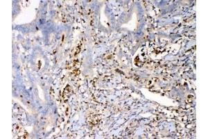 IHC testing of FFPE human rectal cancer tissue with Psoriasin antibody at 1ug/ml. (S100A7 anticorps)