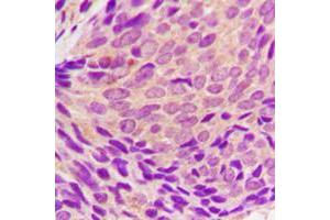 Immunohistochemical analysis of SYK (pY323) staining in human breast cancer formalin fixed paraffin embedded tissue section.