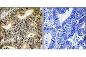 Immunohistochemistry analysis of paraffin-embedded human colon carcinoma, using 4E-BP1 (Phospho-Thr70) Antibody.