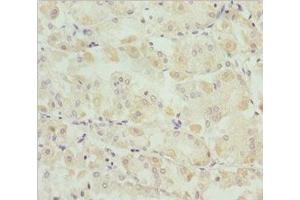 Immunohistochemistry of paraffin-embedded human gastric cancer using ABIN7171149 at dilution of 1:100