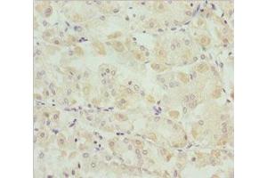 Immunohistochemistry of paraffin-embedded human gastric cancer using ABIN7171149 at dilution of 1:100 (SNAP29 anticorps  (AA 1-258))