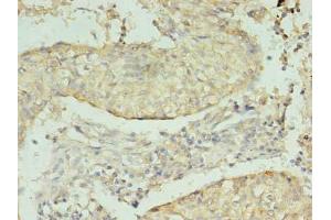 Immunohistochemistry of paraffin-embedded human lung cancer using ABIN7164305 at dilution of 1:100 (Neuregulin 2 anticorps  (AA 112-405))