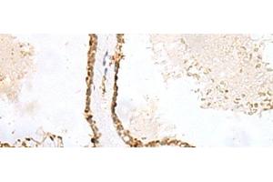 Immunohistochemistry of paraffin-embedded Human thyroid cancer tissue using LPXN Polyclonal Antibody at dilution of 1:60(x200) (Leupaxin anticorps)