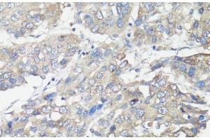 Immunohistochemistry of paraffin-embedded Human liver cancer using MUL1 Polyclonal Antibody at dilution of 1:100 (40x lens). (MUL1 anticorps)