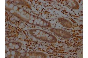 IHC image of ABIN7127612 diluted at 1:100 and staining in paraffin-embedded human colon cancer performed on a Leica BondTM system.