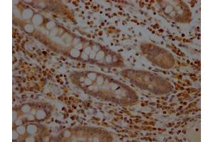 IHC image of ABIN7127612 diluted at 1:100 and staining in paraffin-embedded human colon cancer performed on a Leica BondTM system. (Recombinant MEK1 anticorps)
