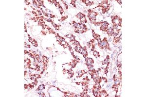 Immunohistochemistry of paraffin-embedded human thyroid cancer using RPL24 antibody (ABIN7269998) at dilution of 1:100 (40x lens). (RPL24 anticorps  (AA 38-157))