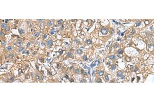Immunohistochemistry of paraffin-embedded Human liver cancer tissue using IGLL1 Polyclonal Antibody at dilution of 1:65(x200) (IGLL1 anticorps)