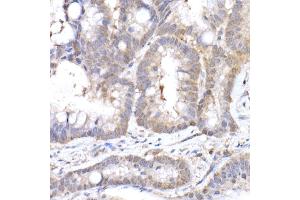 Immunohistochemistry of paraffin-embedded human colon carcinoma using MTAP Rabbit mAb (ABIN7268498) at dilution of 1:50 (40x lens). (MTAP anticorps)