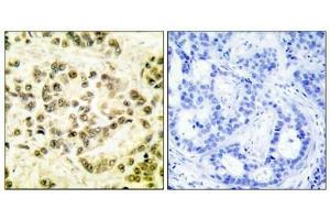 Immunohistochemical analysis of paraffin-embedded human breast carcinoma tissue using STAT5B (phospho-Ser731) antibody. (STAT5B anticorps  (pSer731))