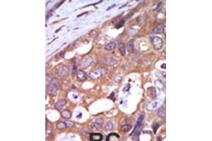 Formalin-fixed and paraffin-embedded human cancer tissue reacted with the primary antibody, which was peroxidase-conjugated to the secondary antibody, followed by AEC staining. (PKC mu anticorps  (N-Term))