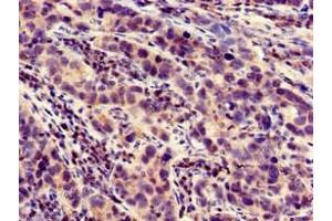 Immunohistochemistry of paraffin-embedded human pancreatic cancer using ABIN7158447 at dilution of 1:100