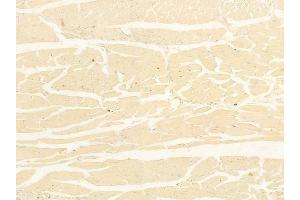 ABIN6262809 and ABIN6278267 at 1/100 staining human tongue carcinoma by IHC-P.