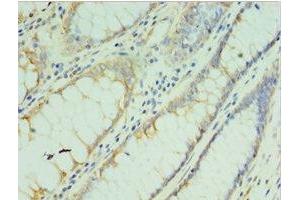 Immunohistochemistry of paraffin-embedded human colon cancer using ABIN7173555 at dilution of 1:100 (TMOD3 anticorps  (AA 1-352))